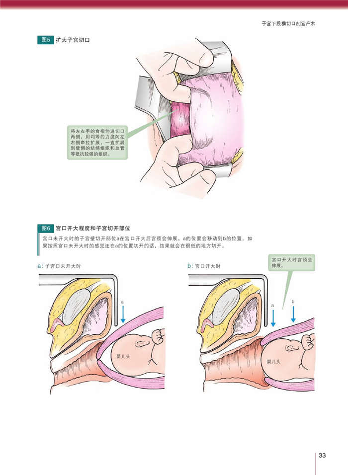 剖宫产图解图片